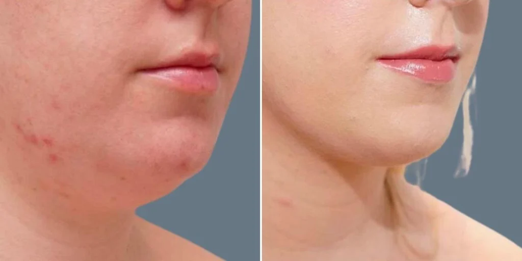 skin neck liposuction lift female pre2024 016 before and after before and after