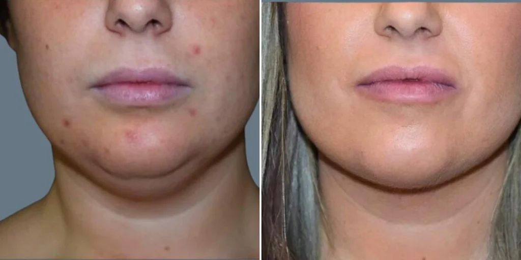 skin neck liposuction lift female pre2024 019 before and after before and after