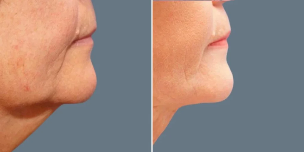 skin neck liposuction lift female pre2024 022 before and after before and after