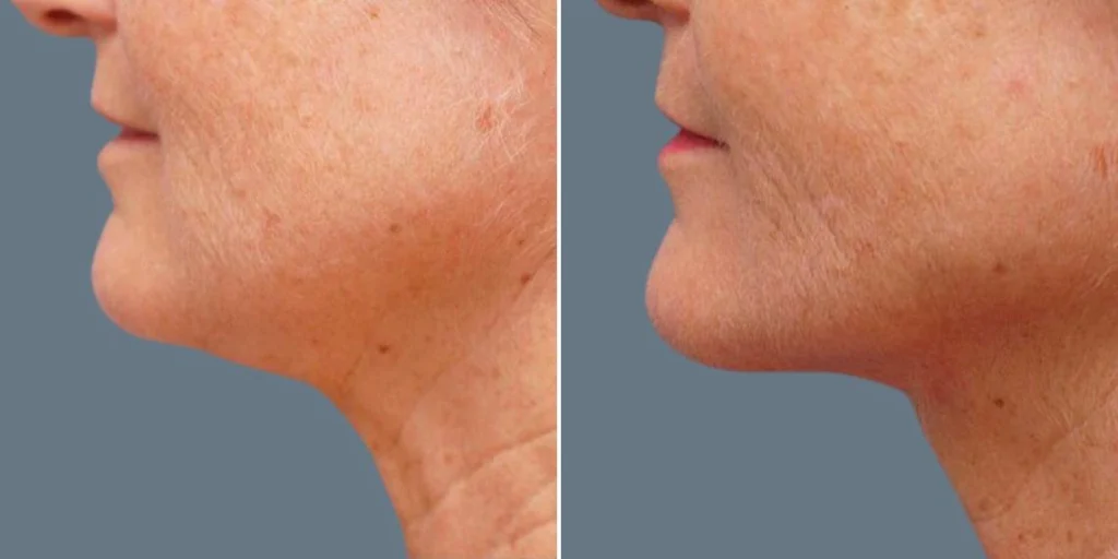 skin neck liposuction lift female pre2024 023 before and after before and after