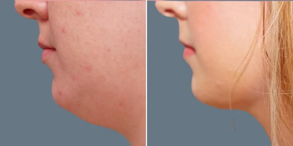 skin neck liposuction lift female pre2024 026 before and after before and after