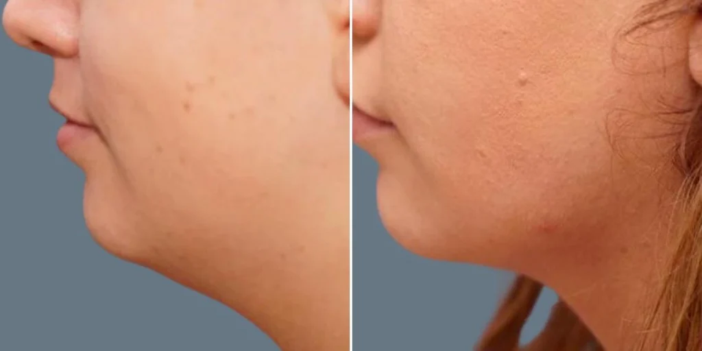 skin neck liposuction lift female pre2024 027 before and after before and after