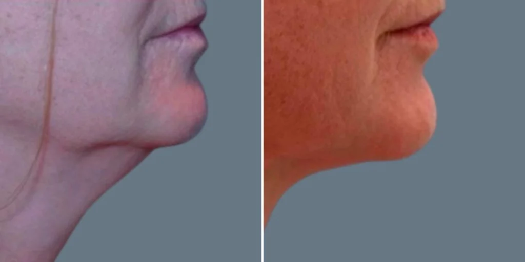 skin neck liposuction lift female pre2024 028 before and after before and after