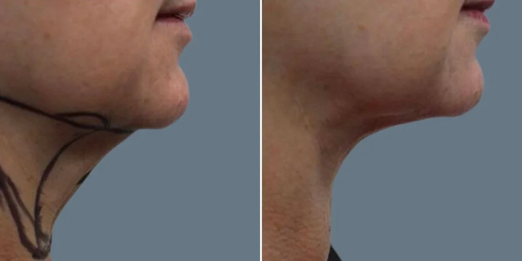 skin neck liposuction lift female pre2024 029 before and after before and after