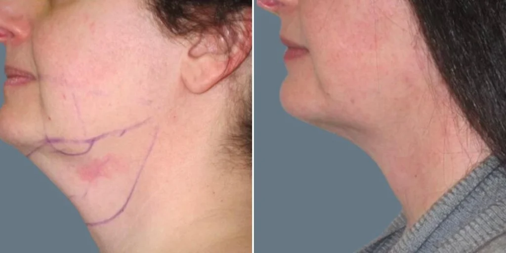 skin neck liposuction lift female pre2024 030 before and after before and after