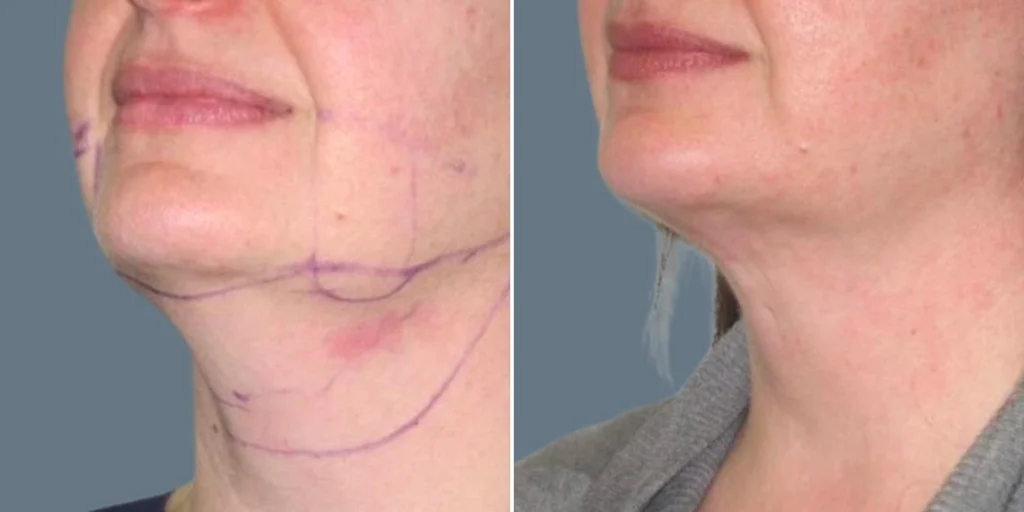 skin neck liposuction lift female pre2024 031 before and after before and after