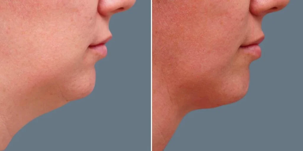 skin neck liposuction lift female pre2024 033 before and after before and after