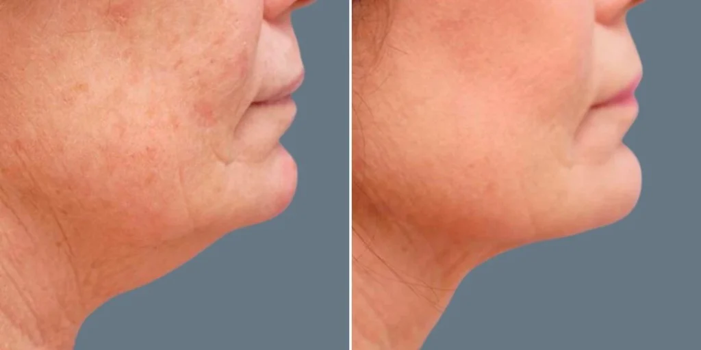 skin neck liposuction lift female pre2024 034 before and after before and after