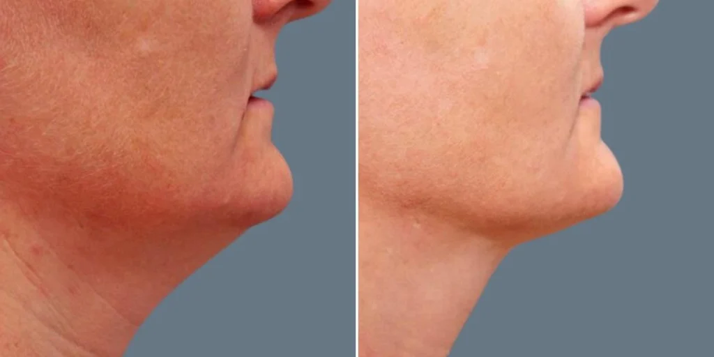 skin neck liposuction lift female pre2024 037 before and after before and after