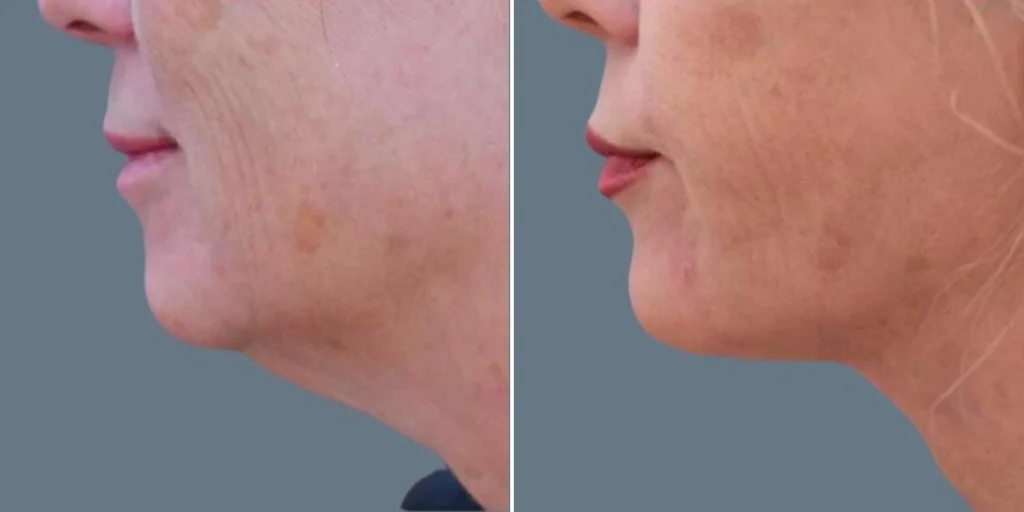 before and after