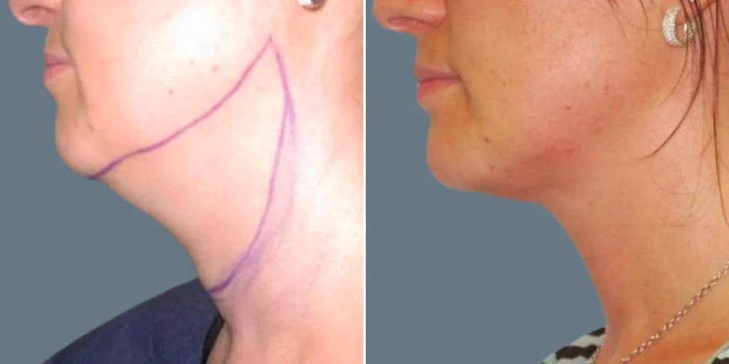 before and after