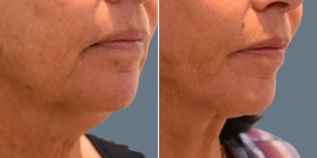 before and after