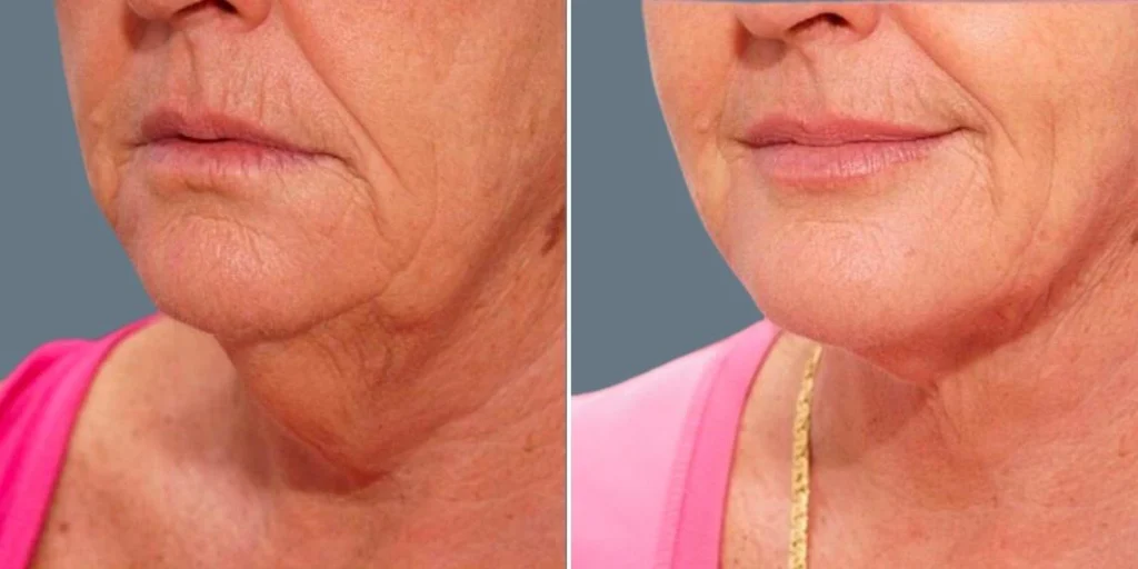 before and after