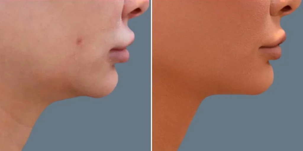 before and after