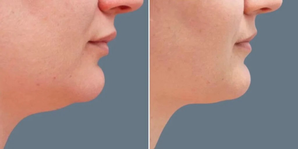 before and after
