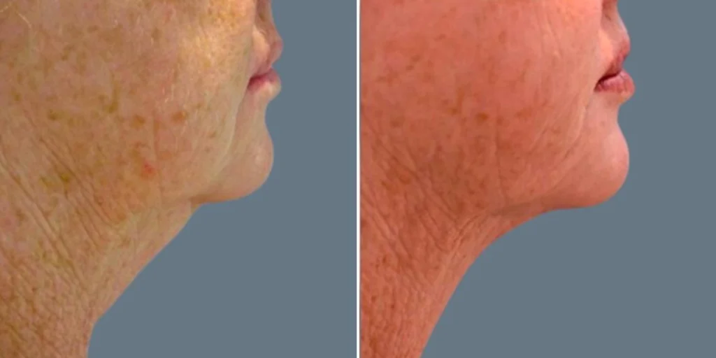 before and after