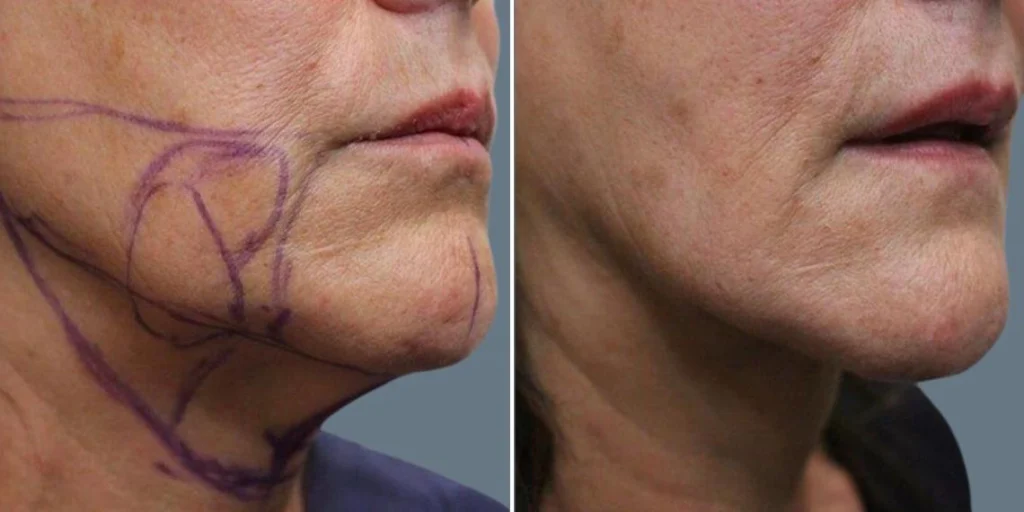 before and after
