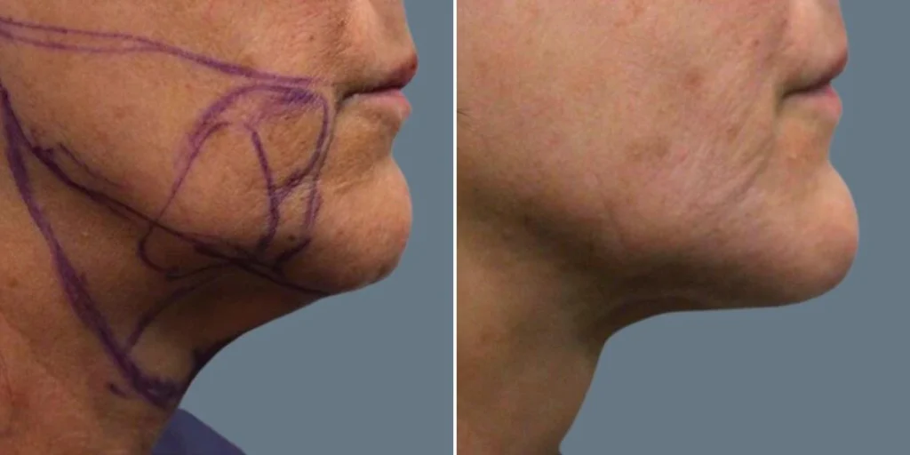before and after