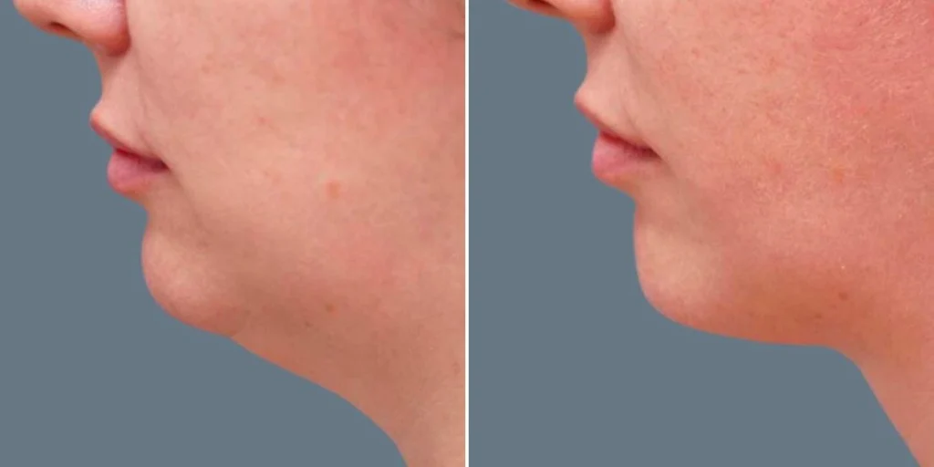 before and after