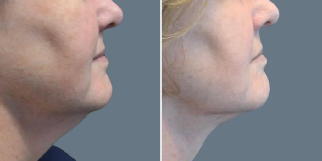 before and after