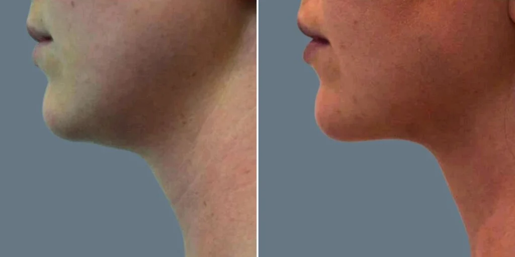 before and after