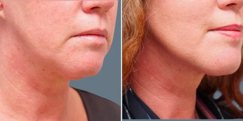 before and after