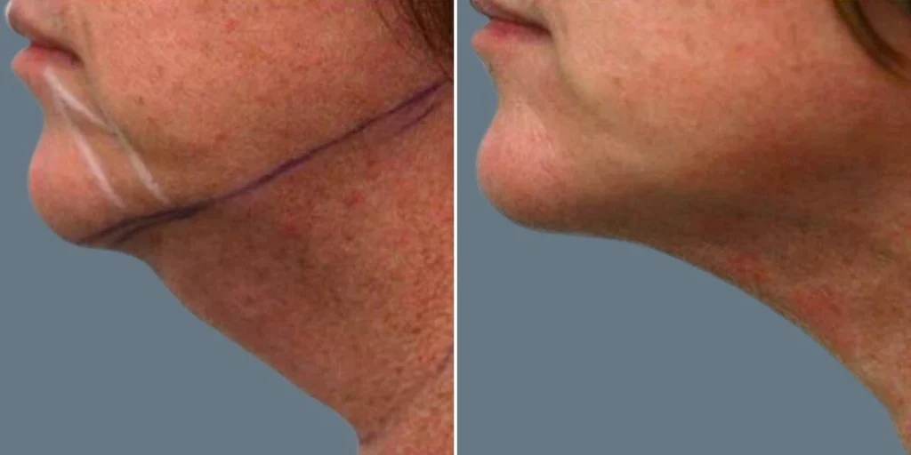 before and after