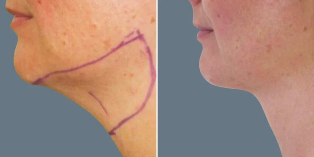 before and after