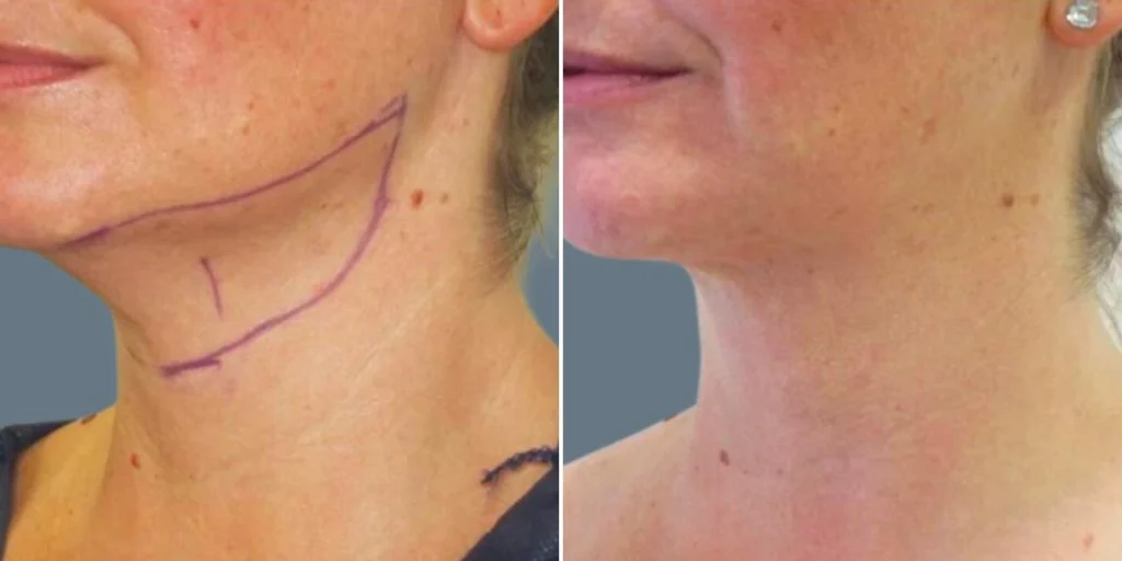 before and after