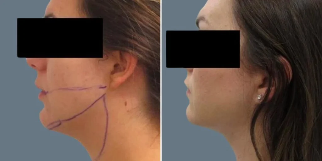 before and after