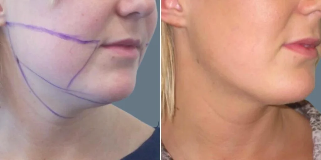 before and after
