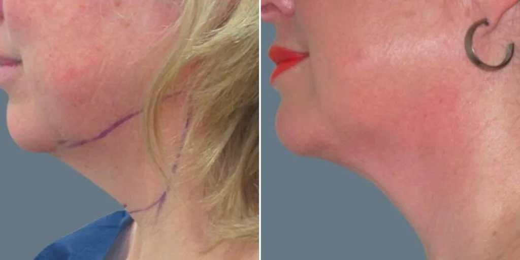 before and after