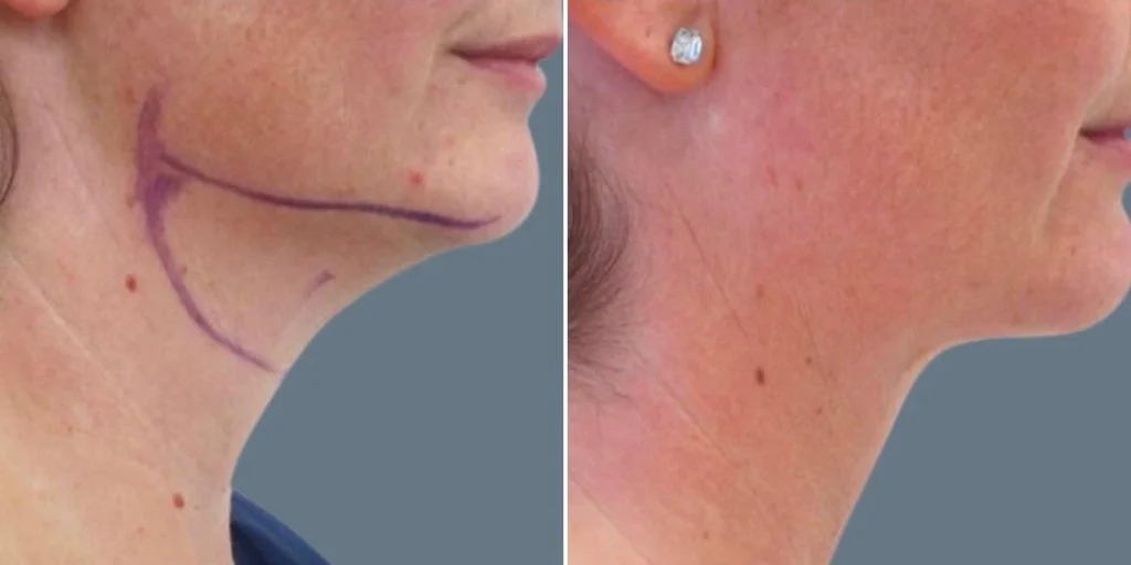 before and after