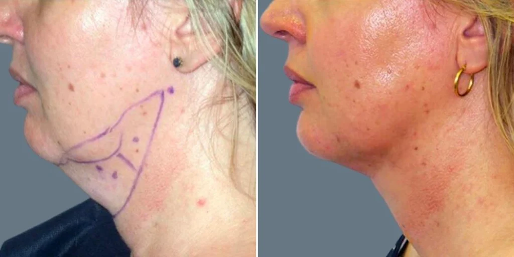 before and after