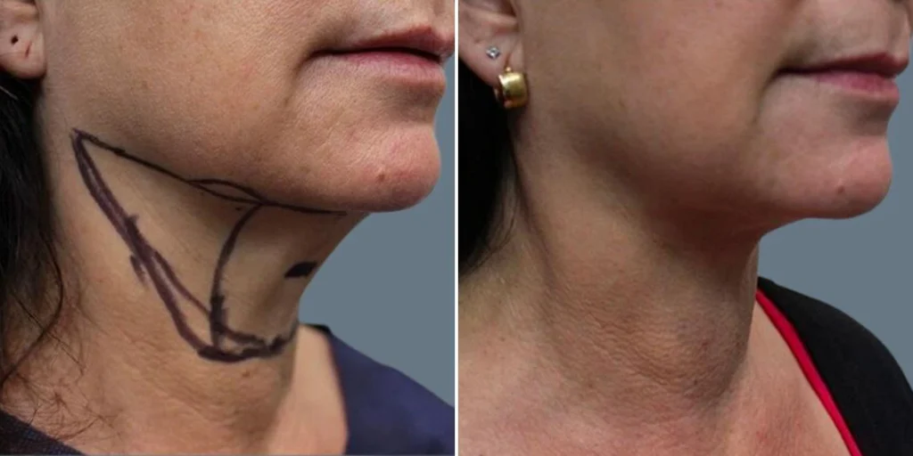 before and after