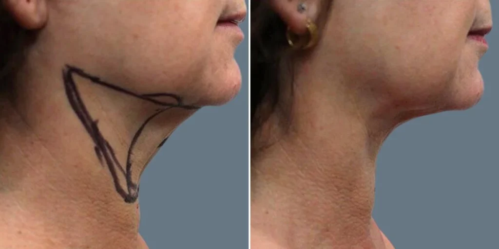 before and after