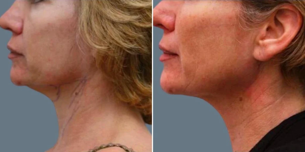 before and after