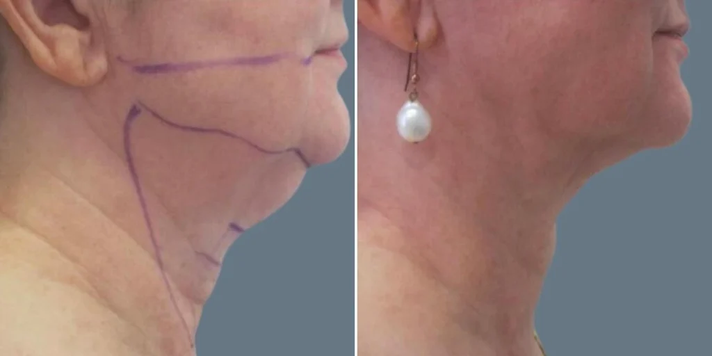 before and after