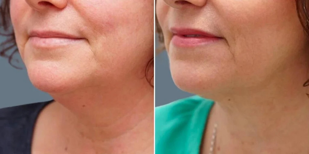 before and after