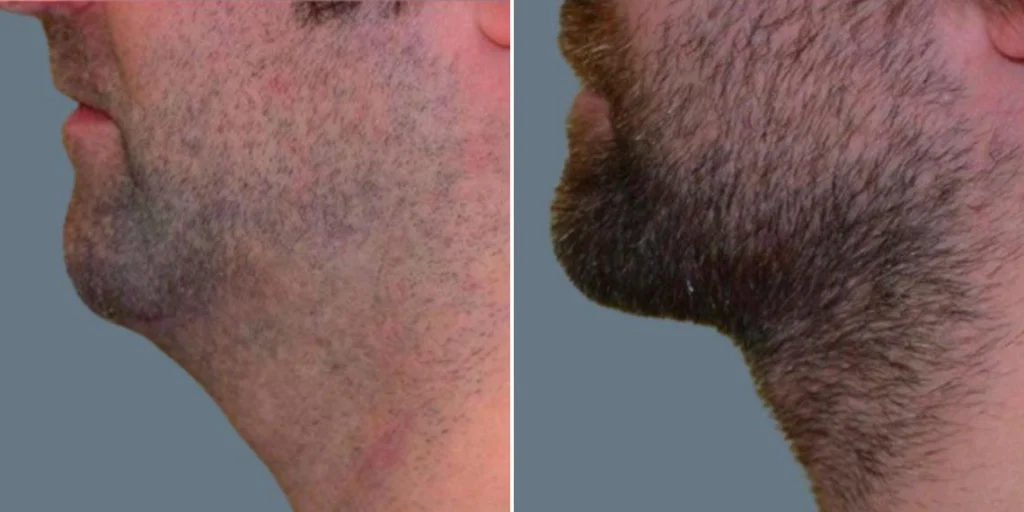 before and after