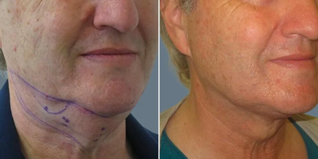 skin neck liposuction lift male pre2024 020 before and after before and after