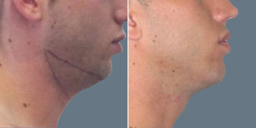 skin neck liposuction lift male pre2024 021 before and after before and after