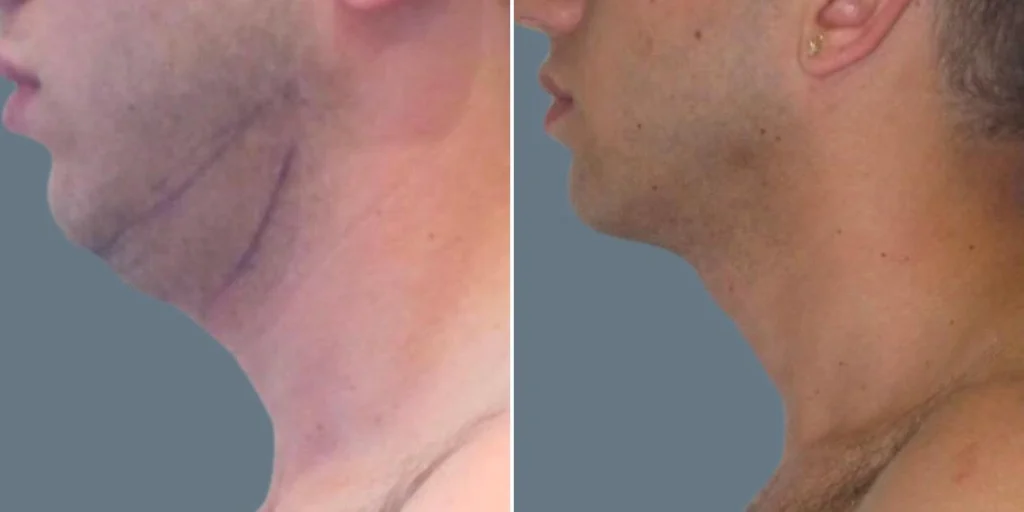 skin neck liposuction lift male pre2024 025 before and after before and after