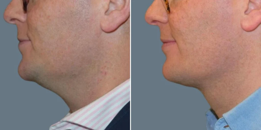 skin neck liposuction lift male pre2024 049 before and after before and after