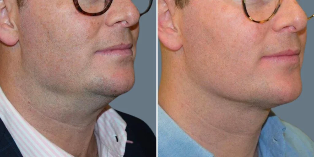 skin neck liposuction lift male pre2024 050 before and after before and after
