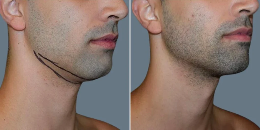 skin neck liposuction lift male pre2024 062 before and after before and after