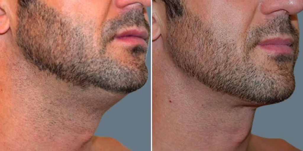 skin neck liposuction lift male pre2024 063 before and after before and after