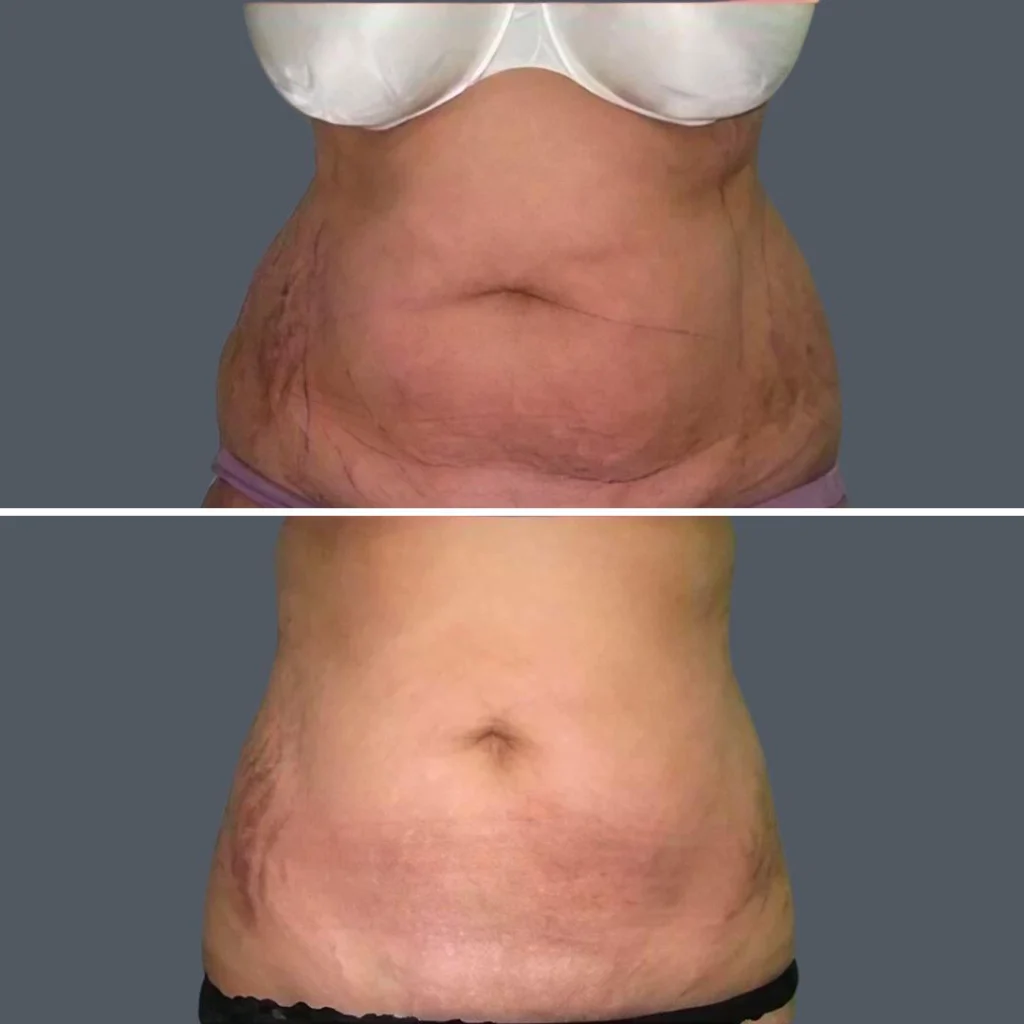 skin tightening female pre2024 002 before and after before and after