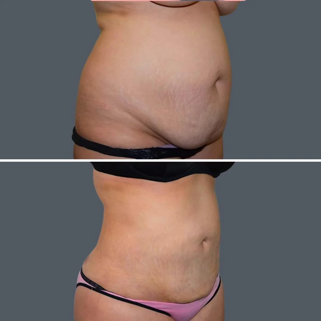 skin tightening female pre2024 003 before and after before and after