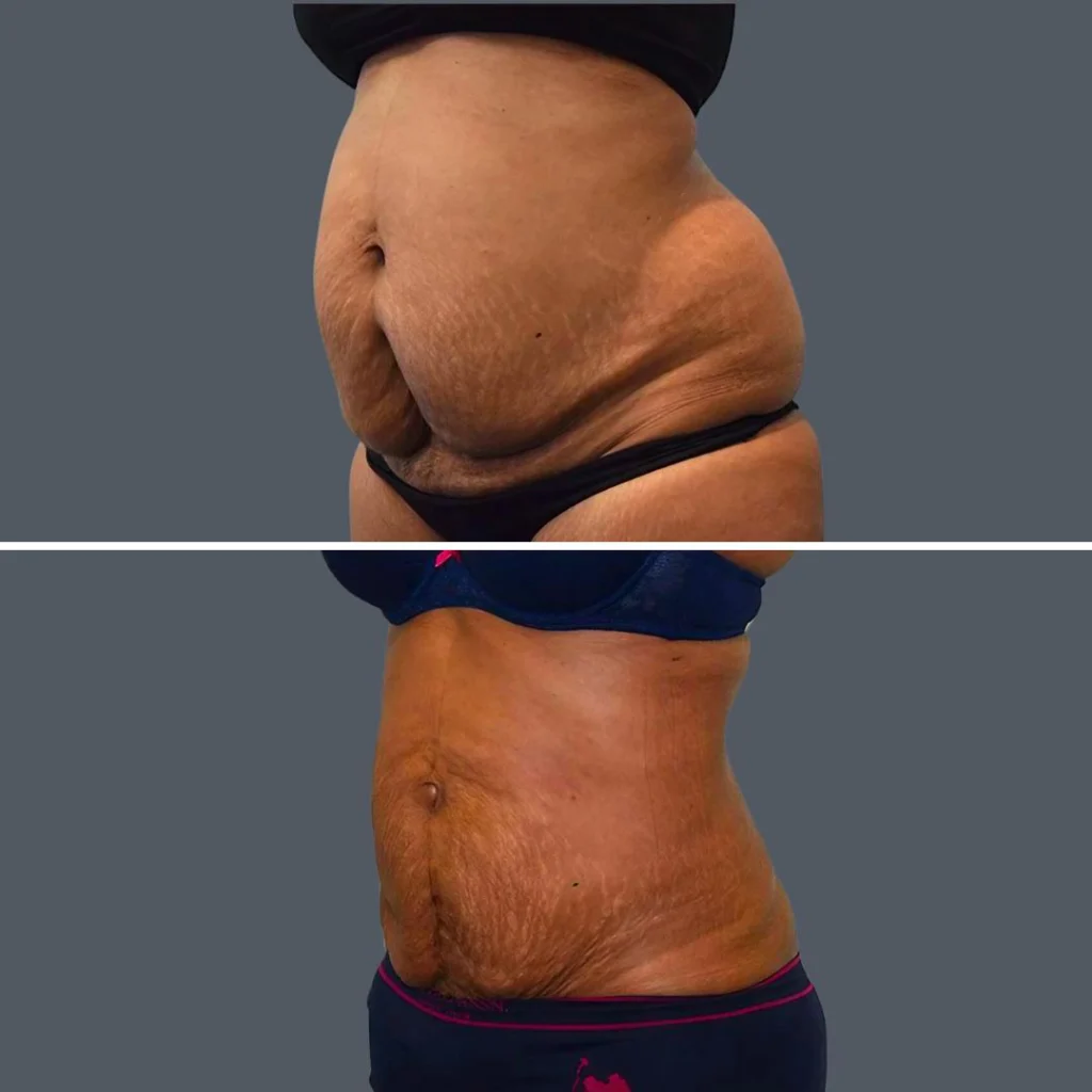 skin tightening female pre2024 004 before and after before and after
